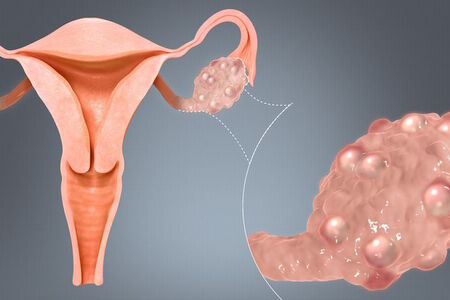 Antimalarikum by mohlo pomoci zmírnit syndrom polycystických ovarií