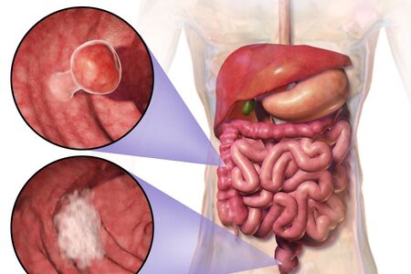 Vědci objevili aminokyselinu, která pomáhá střevům se samoléčbou